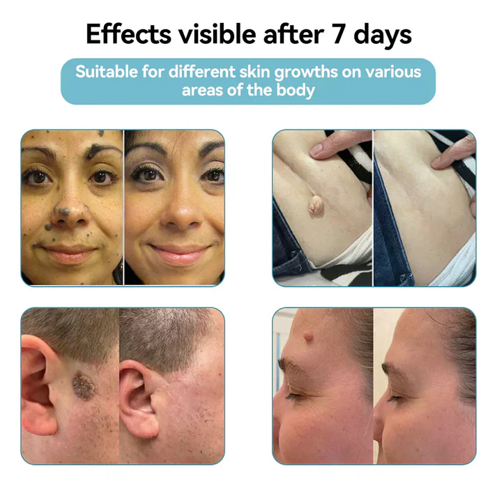 VelvetSkin+ All-in-One CO2Laser Eraser PenRemoves Moles, Warts,Skin Flaws &Pigmentation