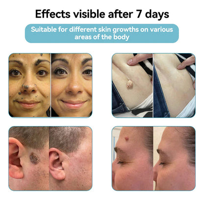 Purekin VelvetSkin+ Medical-Grade Laser Pen (Powered by CO2 laser technology – effectively removes moles, warts, skin tags, pigmentation spots, and other skin imperfections)