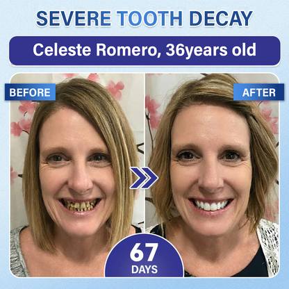 Your Smile🦷Tooth & Gum Repair Fast-Dissolving Microneedle Patch✨ (𝟓-𝐢𝐧-𝟏 💎 𝐑𝐞𝐛𝐮𝐢𝐥𝐝 𝐄𝐧𝐚𝐦𝐞𝐥 & 𝐃𝐞𝐧𝐭𝐢𝐧 • 𝐒𝐭𝐫𝐞𝐧𝐠𝐭𝐡𝐞𝐧 𝐆𝐮𝐦𝐬 • 𝐄𝐫𝐚𝐝𝐢𝐜𝐚𝐭𝐞 𝐓𝐚𝐫𝐭𝐚𝐫 & 𝐎𝐝𝐨𝐫 • 𝐖𝐡𝐢𝐭𝐞𝐧𝐢𝐧𝐠 • 𝐒𝐭𝐨𝐩 𝐓𝐨𝐨𝐭𝐡 𝐒𝐞𝐧𝐬𝐢𝐭𝐢𝐯𝐢𝐭𝐲)