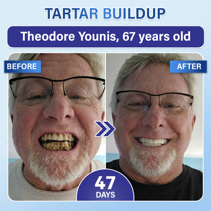 Your Smile🦷Tooth & Gum Repair Fast-Dissolving Microneedle Patch✨ (𝟓-𝐢𝐧-𝟏 💎 𝐑𝐞𝐛𝐮𝐢𝐥𝐝 𝐄𝐧𝐚𝐦𝐞𝐥 & 𝐃𝐞𝐧𝐭𝐢𝐧 • 𝐒𝐭𝐫𝐞𝐧𝐠𝐭𝐡𝐞𝐧 𝐆𝐮𝐦𝐬 • 𝐄𝐫𝐚𝐝𝐢𝐜𝐚𝐭𝐞 𝐓𝐚𝐫𝐭𝐚𝐫 & 𝐎𝐝𝐨𝐫 • 𝐖𝐡𝐢𝐭𝐞𝐧𝐢𝐧𝐠 • 𝐒𝐭𝐨𝐩 𝐓𝐨𝐨𝐭𝐡 𝐒𝐞𝐧𝐬𝐢𝐭𝐢𝐯𝐢𝐭𝐲)