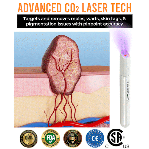 Purekin VelvetSkin+ Medical-Grade Laser Pen (Powered by CO2 laser technology – effectively removes moles, warts, skin tags, pigmentation spots, and other skin imperfections)