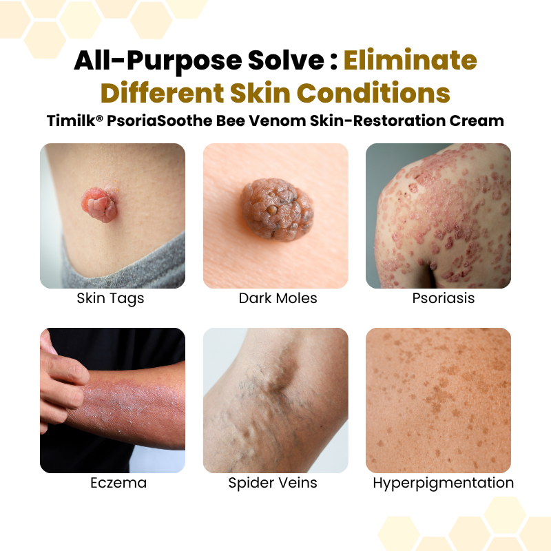 Timik® PsoriaSoothe Bee Venom Skin-Restoration Cream