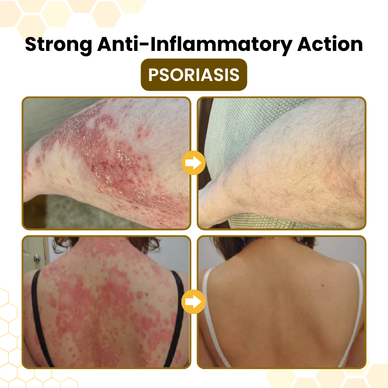 Timik® PsoriaSoothe Bee Venom Skin-Restoration Cream