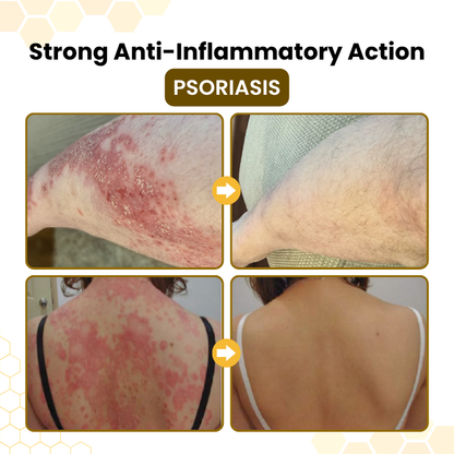 Timik® PsoriaSoothe Bee Venom Skin-Restoration Cream